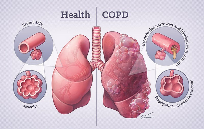 Why is COPD Worse In Morning?. Chronic Obstructive Pulmonary Disease ...