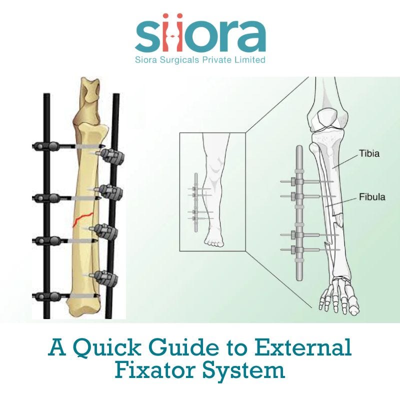 A Quick Guide to External Fixator System - Siora Surgicals - Medium