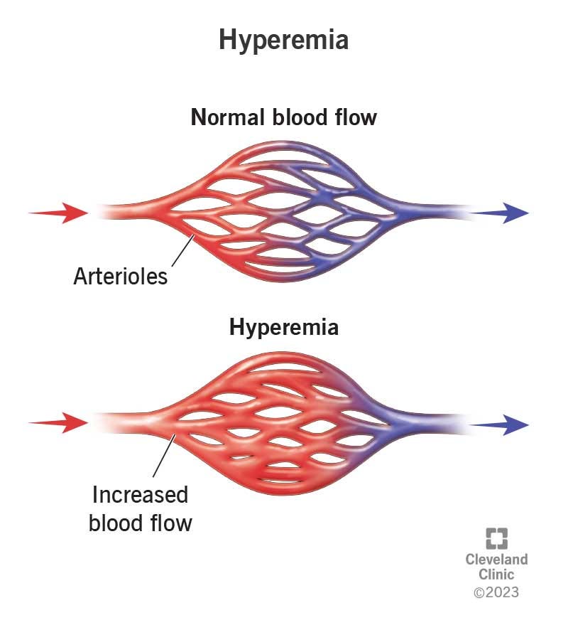 Arterial hyperemia, also known as active hyperemia, refers to an