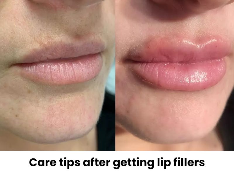 Care tips after getting lip fillers by Apurba Digitalgoogly Feb
