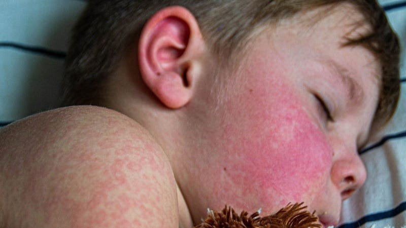 Measles Cases Soar in Florida as Families & Taxpayers Face a Growing Financial Toll