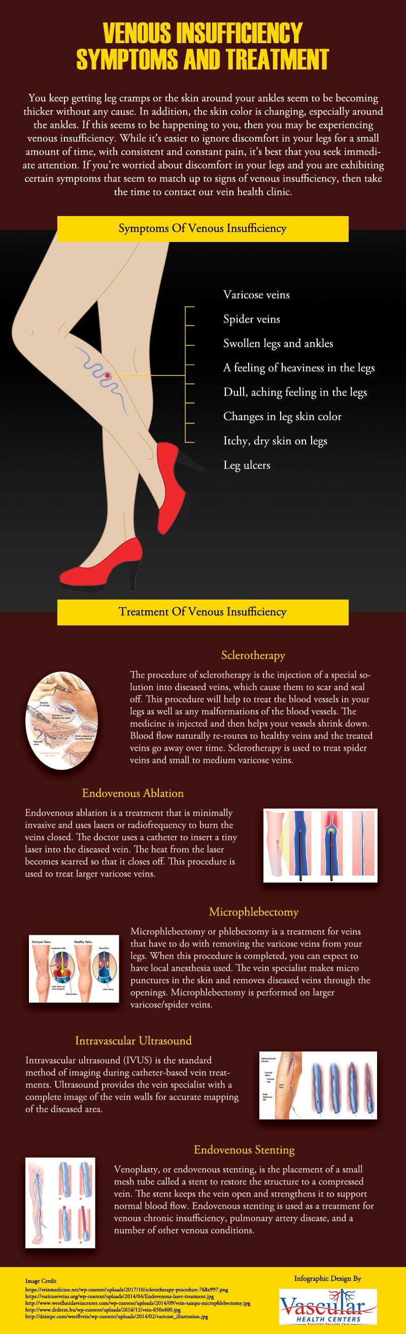 Venous Insufficiency Symptoms & Treatment