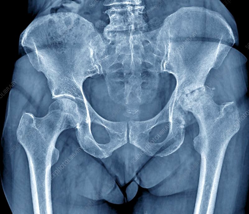 X-Ray Pelvis for Pain or Injury: What Your Report Might Show