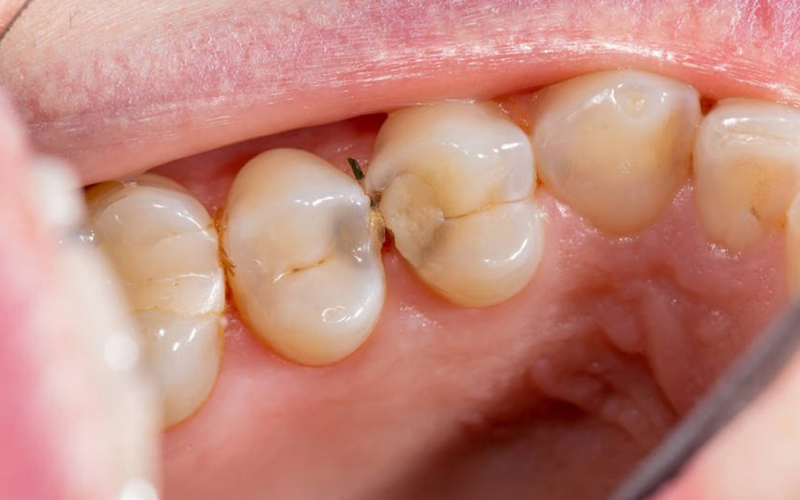 What Does A Cavity Look Like On An XRay? by Wicker Park Dental Group