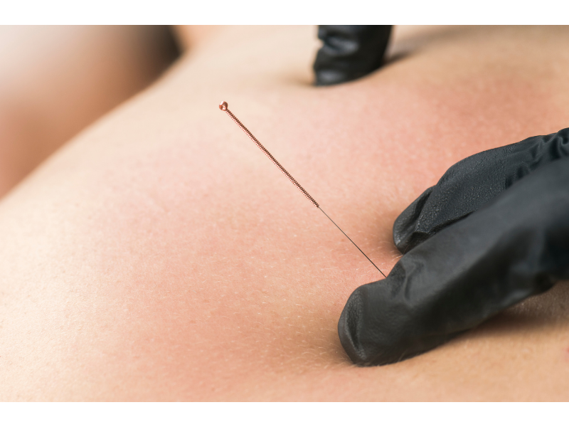 Does dry needling actually work?