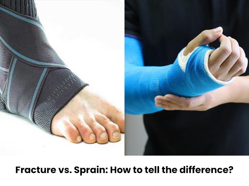Fracture vs. Sprain How to tell the difference? by Apurba Digitalgoogly Jan, 2024 Medium