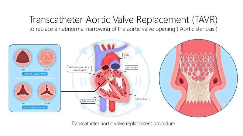 Best TAVI-TAVR Treatment Doctor and Expert in Jaipur, Rajasthan — Dr. Ravinder Singh Rao