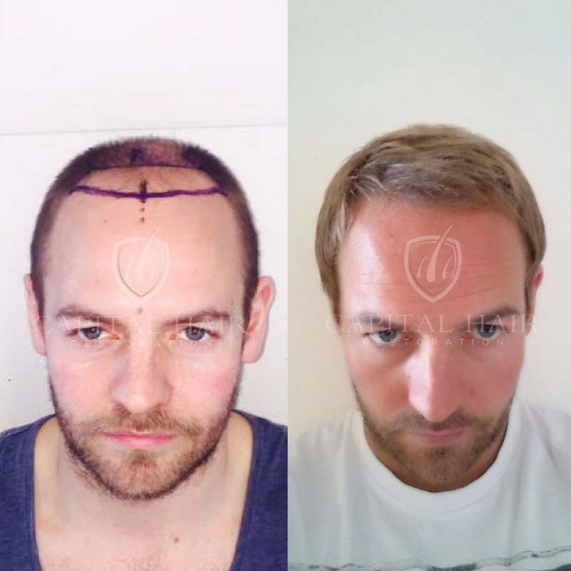 Capital Hair Restoration A Premier Hair Transplantation Clinic in