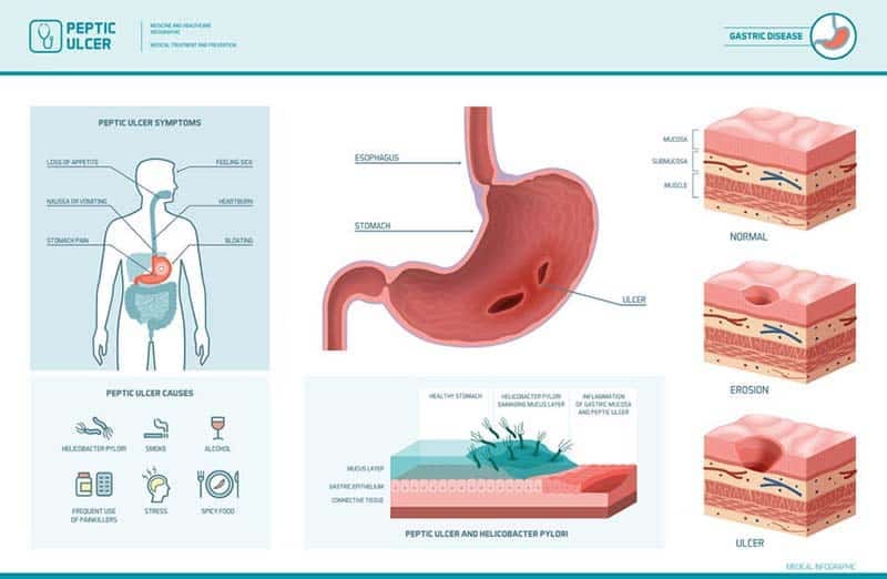 what-is-gastritis-what-does-gastritis-means-by-suraj-shrestha-medium