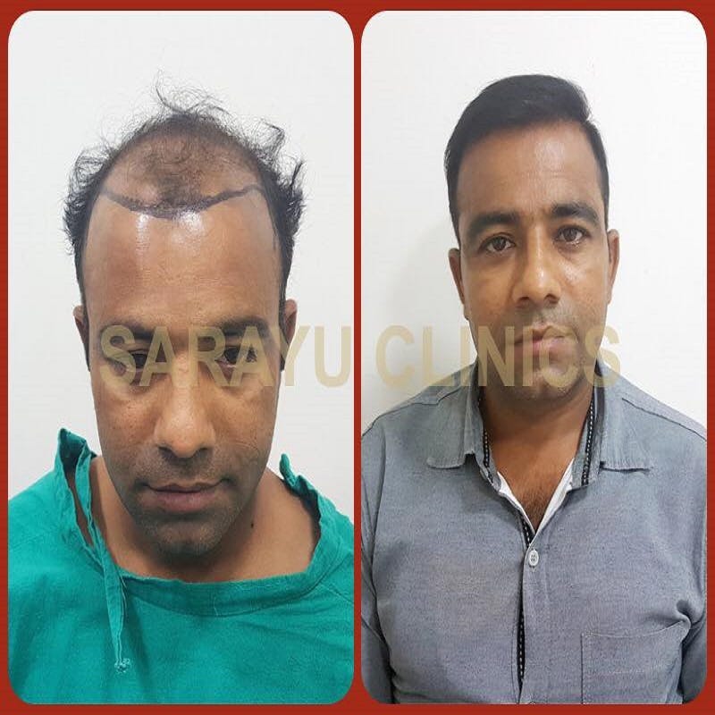 Wigs vs Hair Transplant Which is Best For You? by Sarayu Clinics