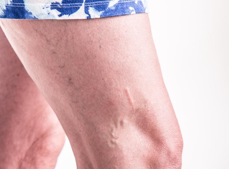 Six Exercises That Will Help Varicose Veins Prevention by Laser