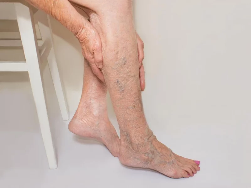 Can varicose veins reoccur after treatment? by Dr Kunal Arora