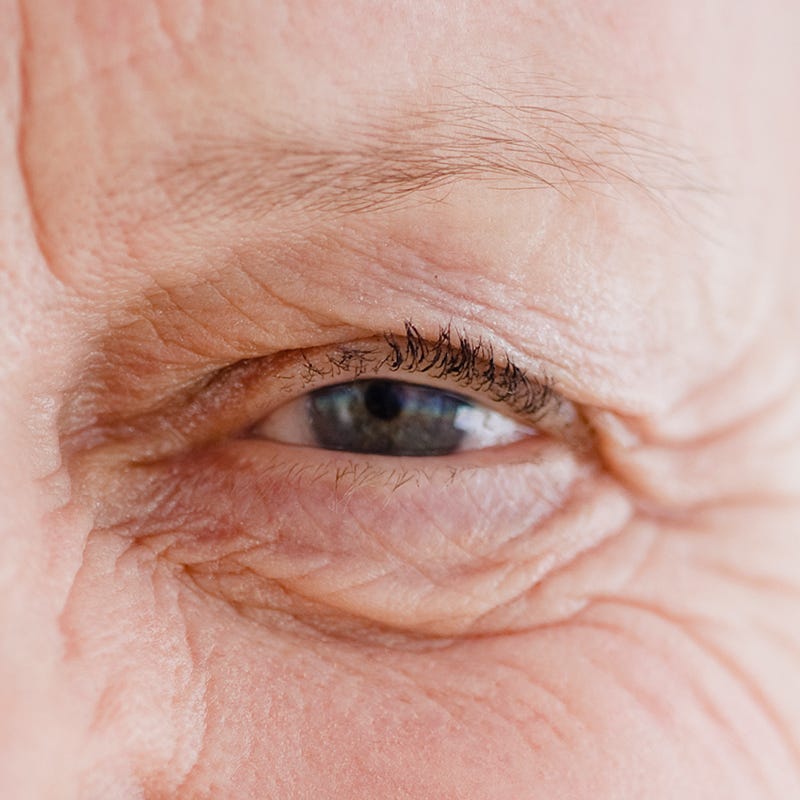 Eyes on the Prize How to Treat and Prevent Wrinkles Around the Eyes