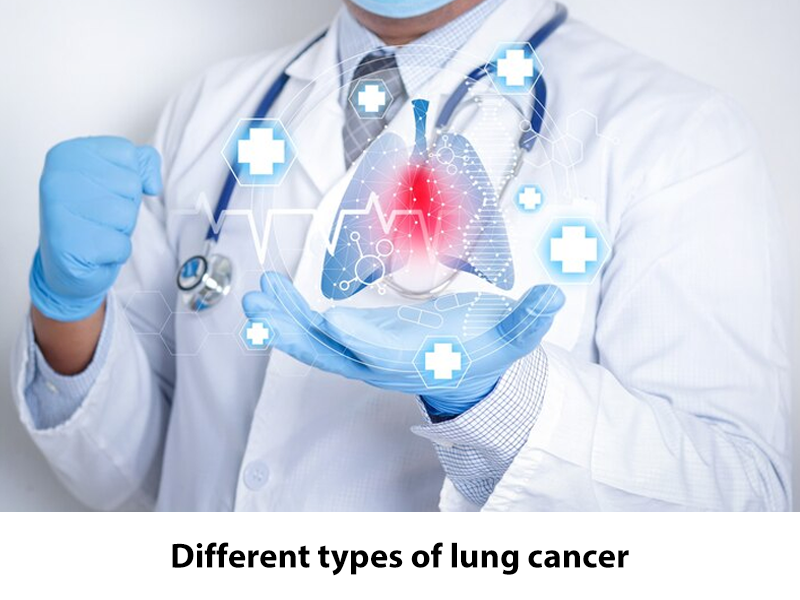 Different types of lung cancer. There are different types of lung… | by ...
