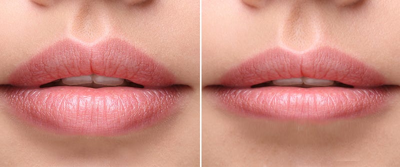 what-is-the-recovery-process-after-lip-reduction-by