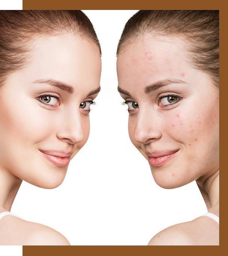 HOW TO GET RID OF FUNGAL ACNE?. How To Get Rid Of Fungal Acne? by