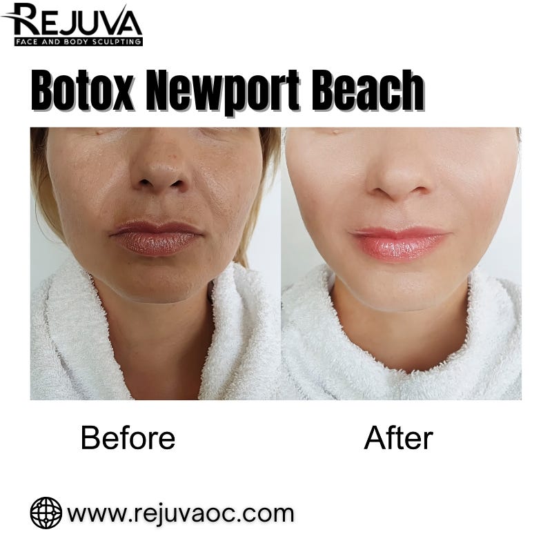 What Botox Newport Beach Patients Actually Experience — From First Appointment to Final Results