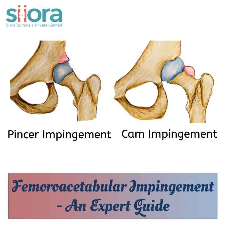Femoroacetabular Impingement — An Expert Guide Siiora Surgical Medium