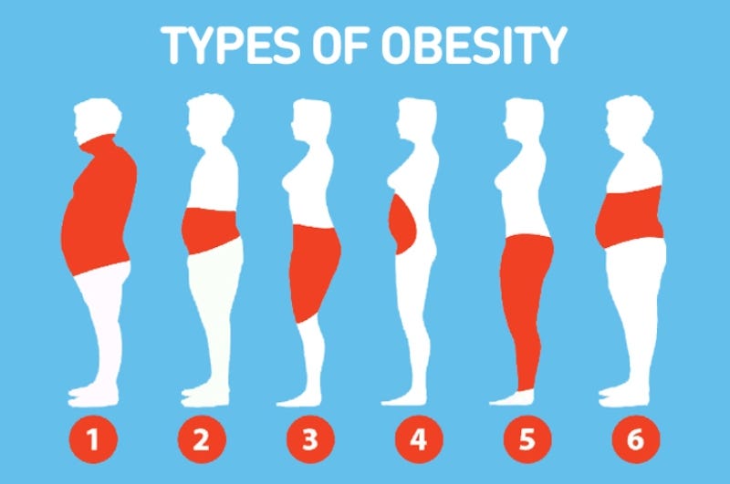 Obesity What You Need to Know. Obesity is a longterm (chronic) health