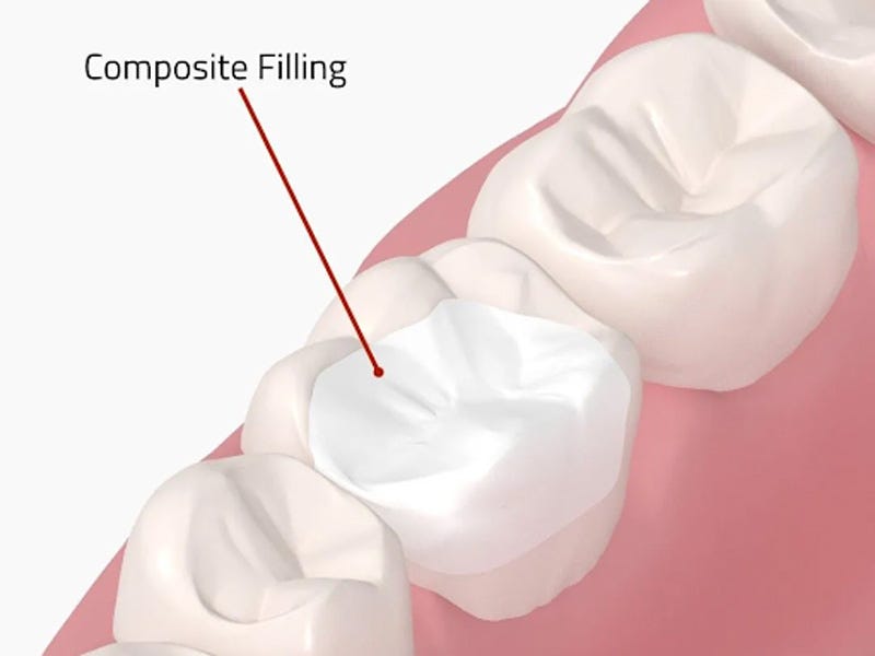 Understanding Why Composite Fillings May Fall Out by Landmark Dental