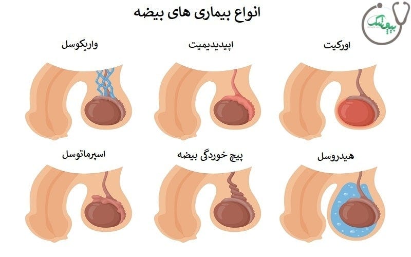 بیماری های بیضه مردان