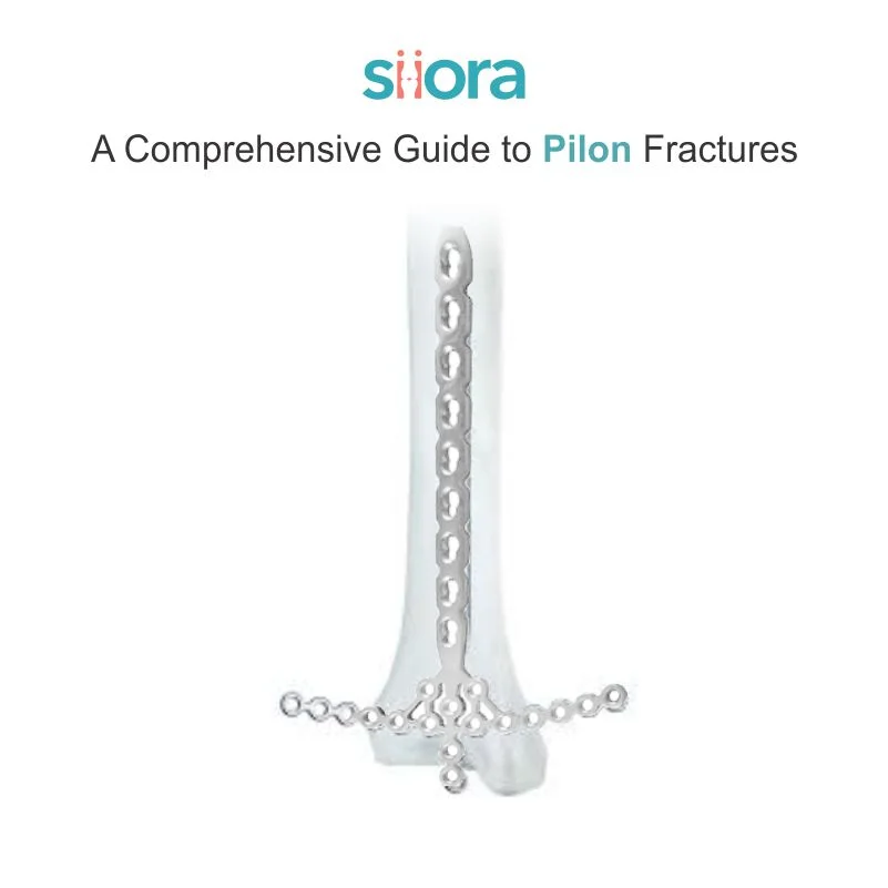 A Comprehensive Guide to Pilon Fractures Siora Surgicals Pvt Ltd Medium