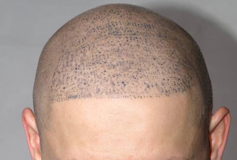 Precision and Excellence: Scalp Micropigmentation in Dubai | by Bisma  Dynamic | May, 2024 | Medium