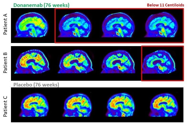Eli Lilly and Company Alzheimer’s Drug Donanemab Slows Cognitive and Functional Decline in Phase 3…
