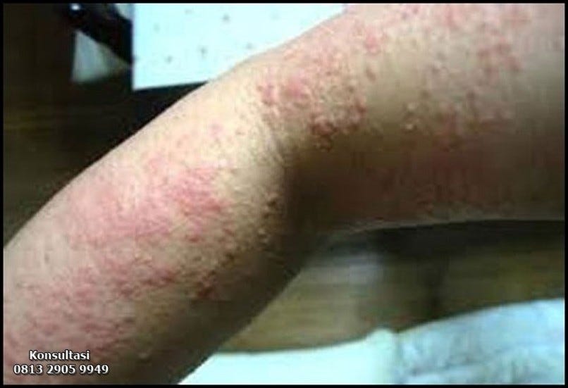 Gambar Kurap Yang Sudah Sembuh. Gambar Kurap Yang Sudah Sembuh — Di