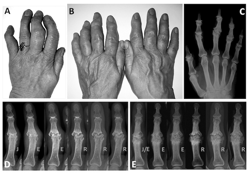 Detect, Score, Explain: Anatomy of an ML Pipeline for Hand X-Rays