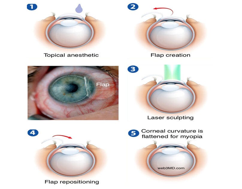 Cost Of Lasik Surgery In Mumbai Cost Of Lasik Surgery In Mumbai