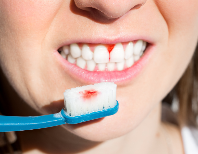 Understanding Gingivitis Causes, Symptoms, and Treatment Options by