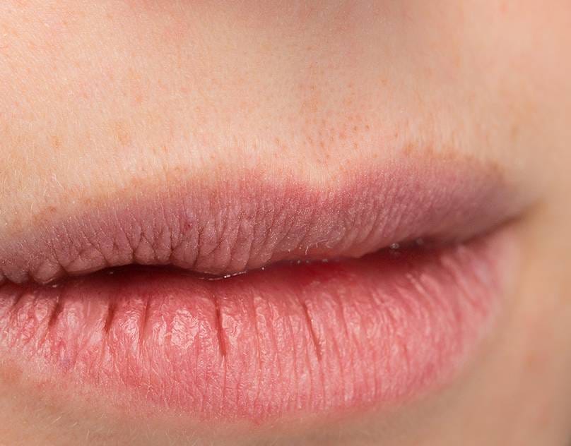How to Fix Chapped Lips to Know miamimd Medium