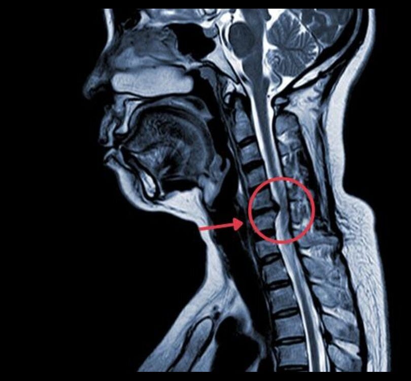 Cervical Myelopathy | Best Neck Pain Specialist Mumbai, India | Synapse ...