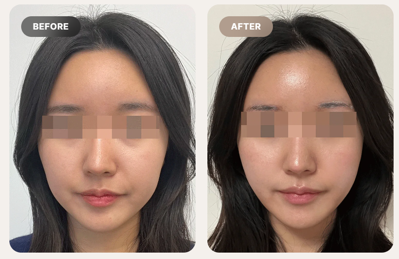 How Often Should You Repeat Ultherapy?