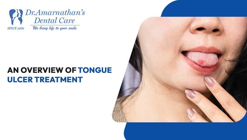 An Overview of Tongue Ulcer Treatment — 2024
