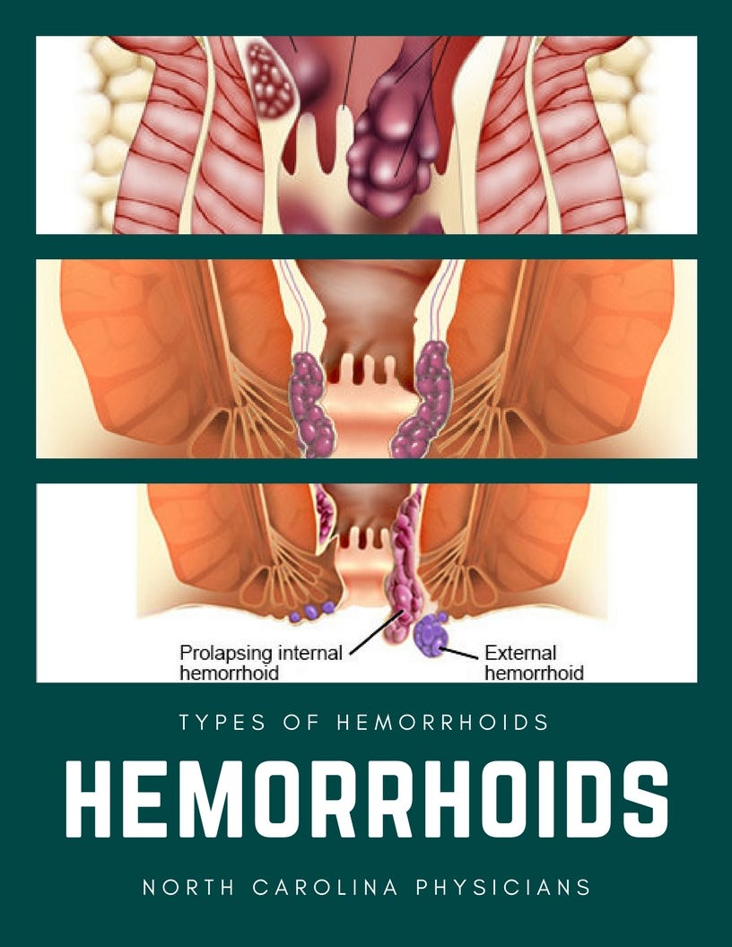 Different Types Of Hemorrhoids-Stages and Symptoms