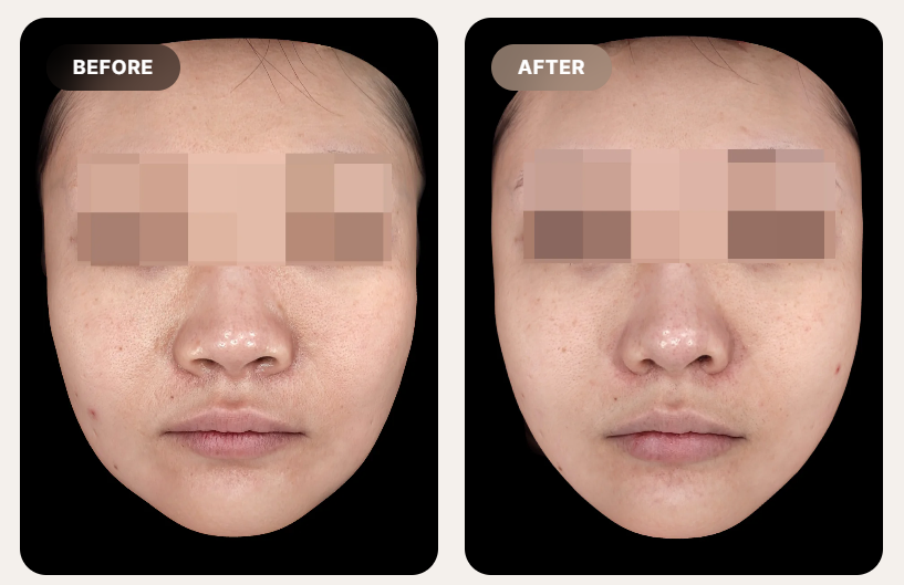 Before and After Ultherapy Treatment