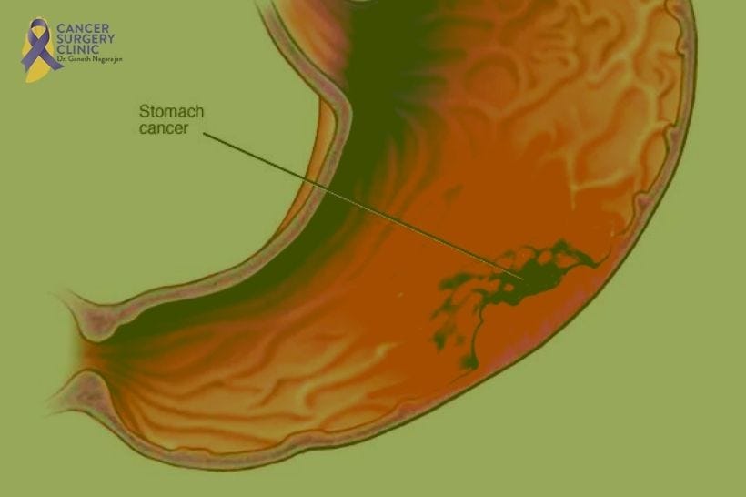 Gastric Cancer Clinic In Mumbai - Dr. Ganesh Nagarajan - Medium