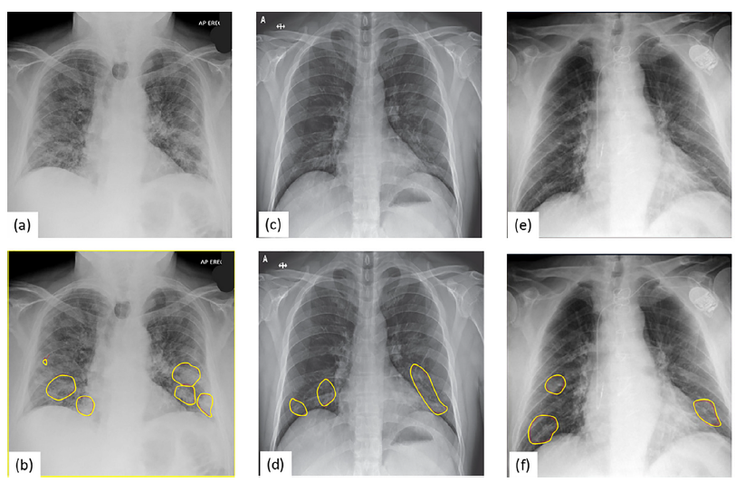 Brief Review — Deep-COVID: Predicting COVID-19 from chest X-ray images ...