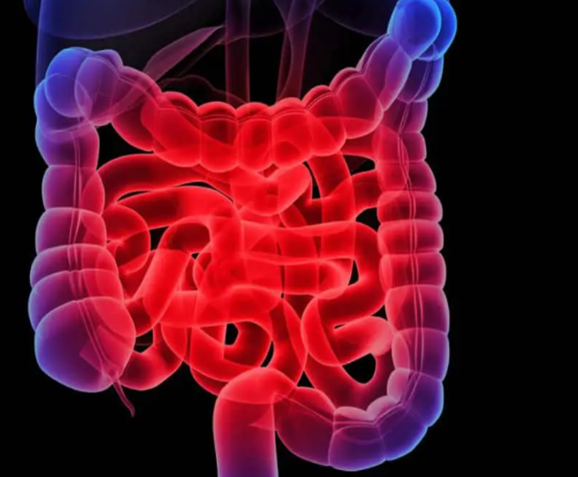 Crohn’s Disease among Second Generation South Asians — Disorders by Aryan Shashi