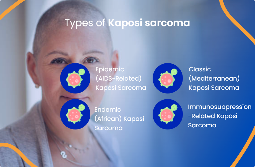 Unraveling Sarcoma Kaposi: A Comprehensive Guide To Understanding And ...