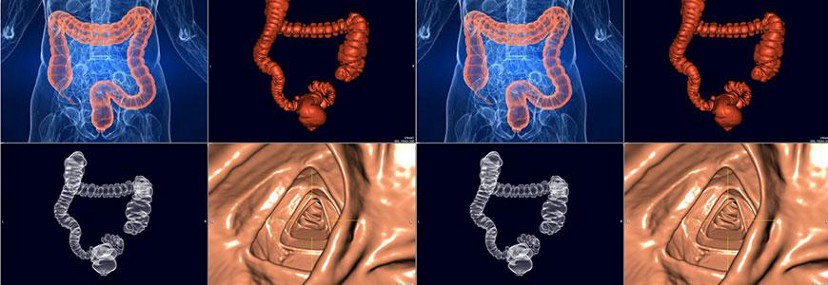 CT Virtual Colonography. Available at: Auburn, Burwood, Campsie… | by ...