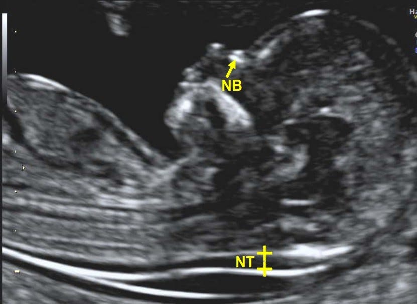 Ultrasonography during Pregnancy Part 2: Nuchal Translucency (NT) Scan ...