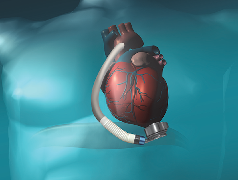 Mechanical Pumps that Help the Heart Pump More Efficiently are Known as