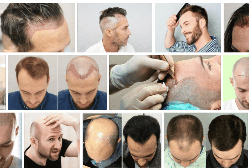Hair Transplant In Kolkata. Hair transplant is a surgical procedure