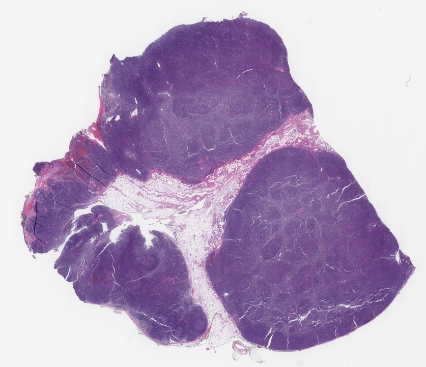 Nodular Lymphocyte Predominant Hodgkin Lymphoma & Associated Foci Of ...