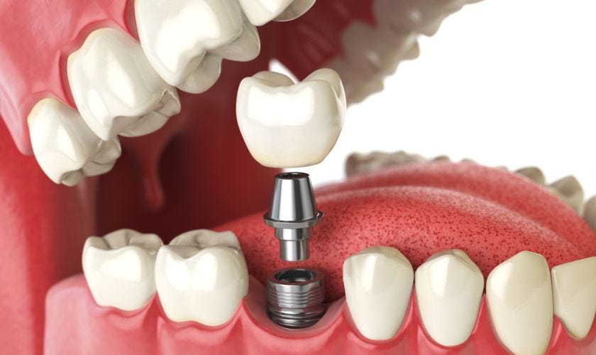Can dental implants be done in one day? by Biltmore Cosmetic