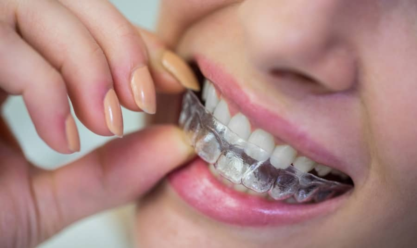 Can Invisalign Work with Crowns? Here’s What You Need to Know by Omni