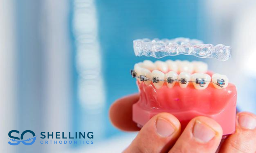 What Is An Invisalign And How Is It Different From Braces? by Shelling Orthodontics Boca Raton